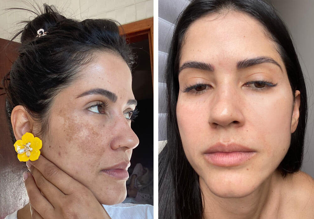 Tratamento de Melasma